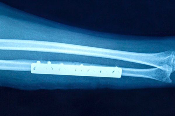 Image of an xray of an arm with metal plates and screws